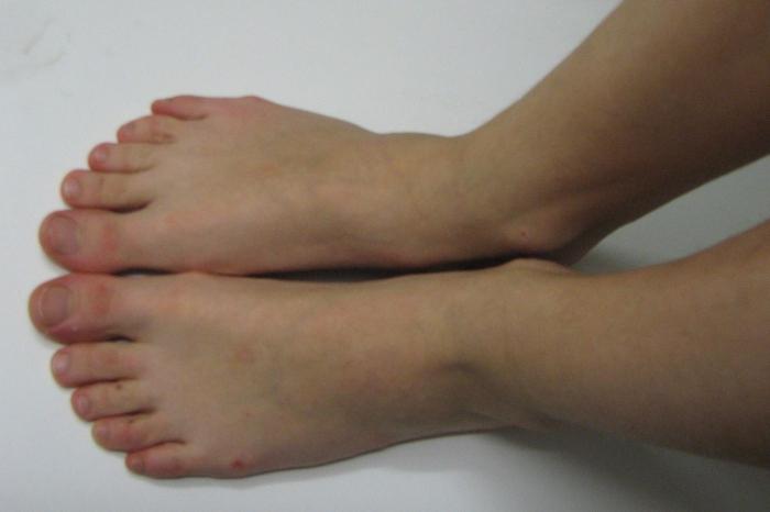 πώς να αφαιρέσετε τα χτυπήματα στα δάκτυλα των ποδιών